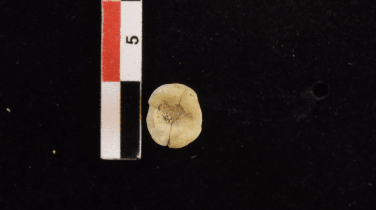 Worn tooth on the right. Black, red and white measuring device is next to the tooth on the left.